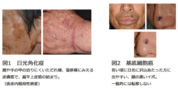 発疹はがんの兆候である可能性がありますか?